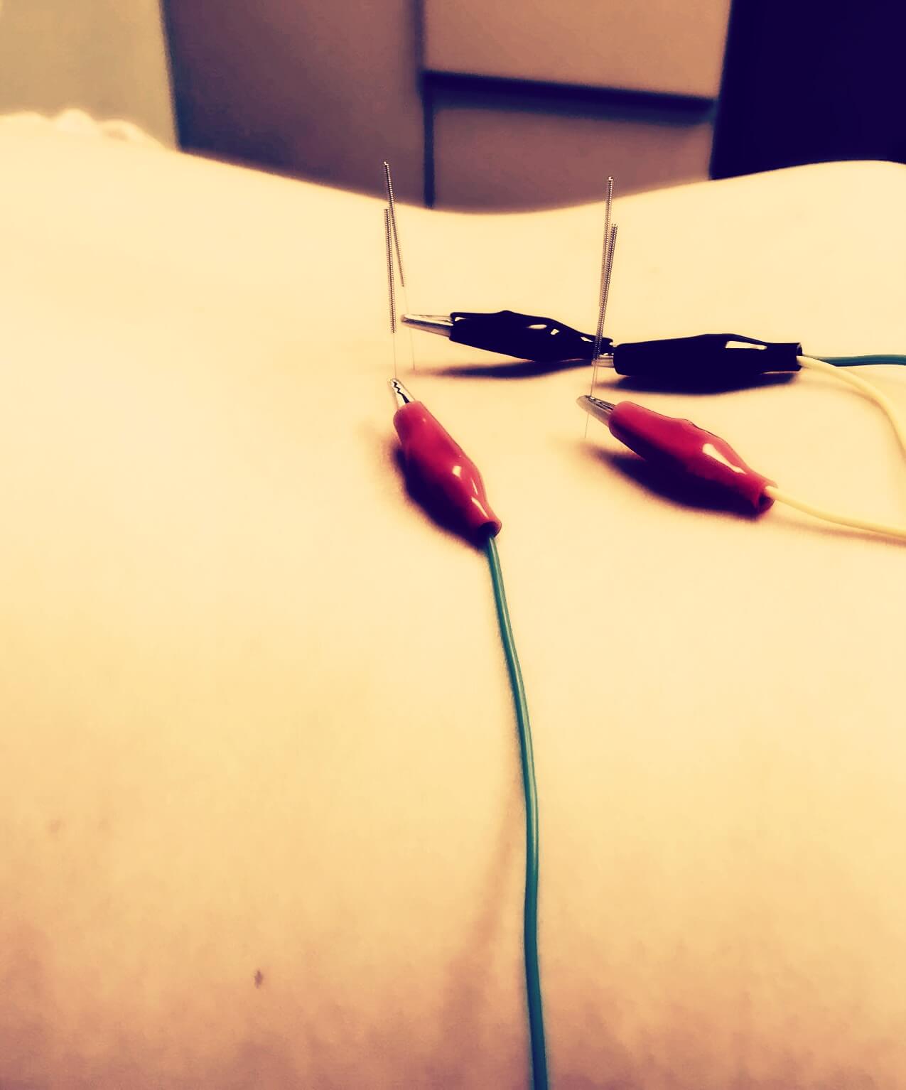electro acupuncture
